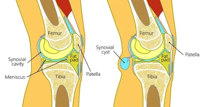 Бурсит коленного сустава | Все о лечении суставов и позвоночника |  ГлавМедЦентр | Дзен