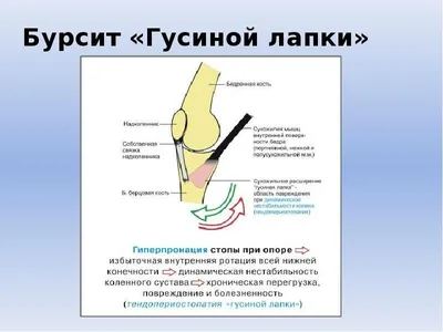 Энтезопатия - Первая Медицинская Клиника