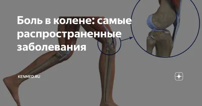Киста Бейкера коленного сустава - Лечение без операции в Киеве | Чем опасна  Киста Бейкера