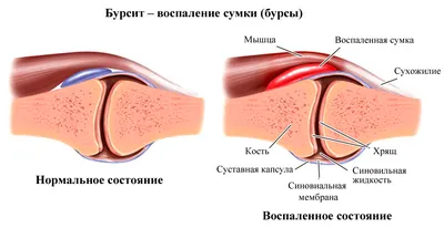 Бурсит - это | причины, симптомы, диагностика, лечение воспаления  синовиальной сумки