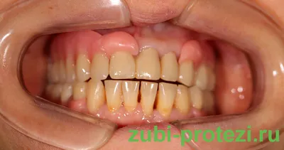 Съемные зубные протезы на верхнюю челюсть: какой материал выбрать?
