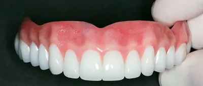 Съемный зубной протез на верхнюю челюсть купить в Denta-Labor | Полные съемные  протезы при полном отсутствии зубов на верхней челюсти цена