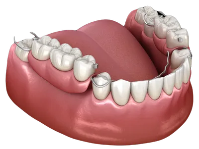 Частичный съемный протез зубов – виды, фото, отзывы