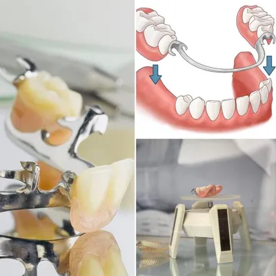 Съемные зубные протезы полной потере зубов в клинике Адалдент