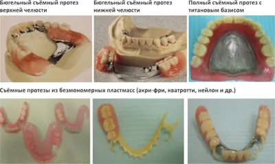 Съемные зубные протезы и их минусы, плюсы несъемного протезирования зубов  от Dominanta