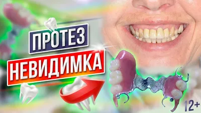 Съемные зубные протезы нового поколения без неба в Москве, цена от 12 000 ₽