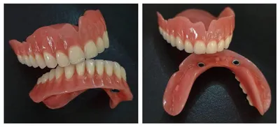 Съемные зубные протезы на имплантатах. Клиника профессора Абакарова