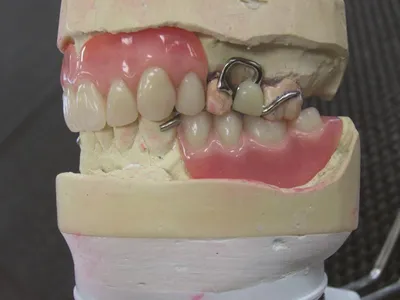 Съемные протезы верхних зубов - цена от 15000 ₽ в Санкт-Петербурге |  клиника Медикор
