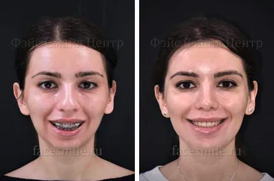 Челюстно лицевая хирургия фото до и после фотографии
