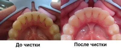 Черный налет на зубах: как убрать?