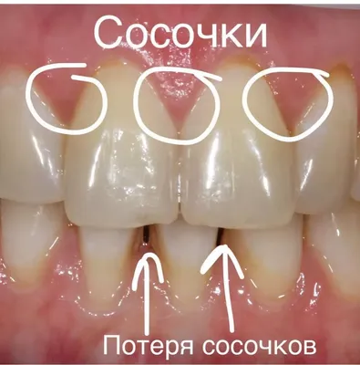 Чистка зубов ультразвуком