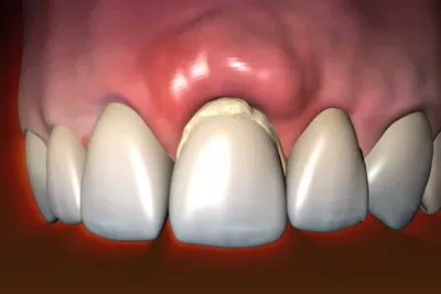 Что делать, если потемнел край коронки? Оголение корня зуба