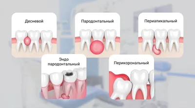 Белый налет на десне после удаления зуба — что означает налет на ране в  лунке после удаления зуба мудрости?