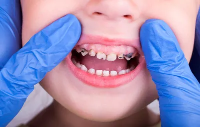 Черные зубы у детей фото фотографии