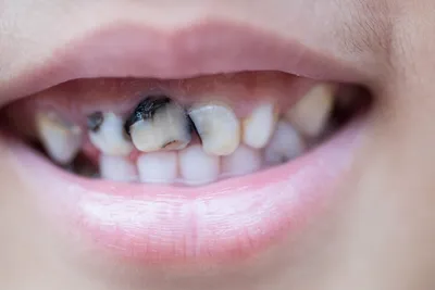 Черные молочные зубы: виды, причины, лечение | СКАЙКЛИНИК