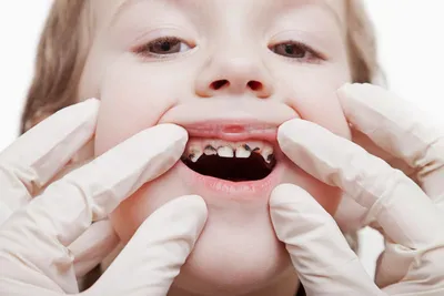 Зубы у детей черные: Понимание причин и решения проблемы потемнения  молочных зубов у малышей