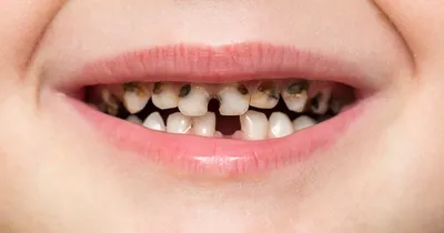 У ребёнка почернели зубы: в чём причина и что теперь делать | Мел