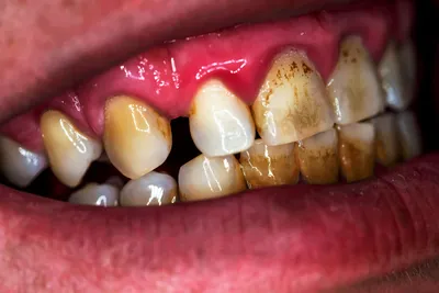Черный налет на зубах: как удалить – стоматология ПрезиДЕНТ