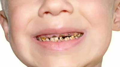 Кариес молочных зубов у детей: цены, показания и рекомендации |  Стоматологические услуги в клинике Церекон в Москве