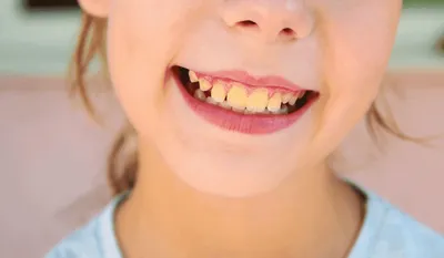 Налет на зубах у ребенка — Air flow чистка в Минске