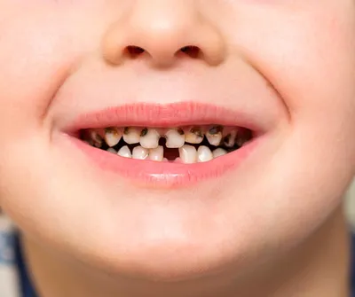 Пятна на зубах и черные зубы у детей - Дибирмагомед Закигаджиевич Омаров
