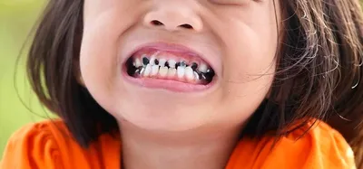 Что делать, если у ребенка чернеют зубы | TopDent | Дзен