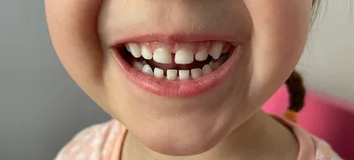 Черные зубы у очень маленьких детей» и другие проблемы. Компетентно об  уходе за детскими зубами | bobruisk.ru