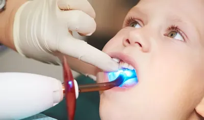 Лечение кариеса молочных зубов у детей, цена в Москве