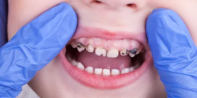 У ребенка чернеют молочные зубы - почему, что делать