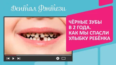 Гнилые зубы у детей: причины, симптомы, лечение | Хорошая Стоматология