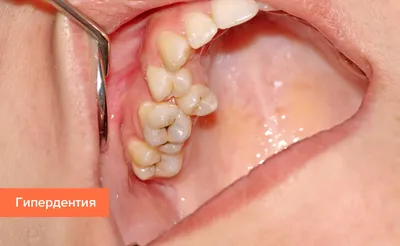 Чёрные зубы в 2 года🤯 Как мы спасли улыбку ребёнка - в конце видео🙌🏻 -  YouTube