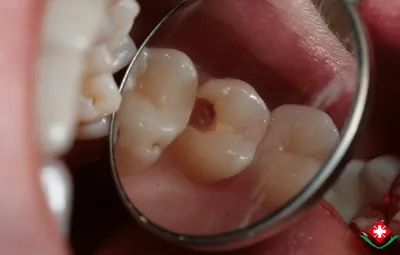 Педиатр: черный налет на зубах ребенка не нуждается в миллионе анализов |  GreenPost