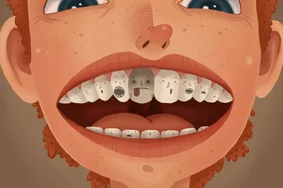 Как убрать зубной налет - стоматология Илатан