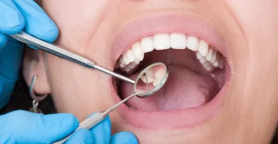 Почему чернеют зубы у детей - клиника эстетической стоматологии Ирины  Зайцевой | Частная практика Ирины Зайцевой