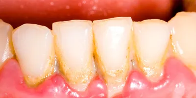 Советы по лечению почерневших зубов