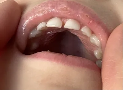 Серебрение зубов у детей: особенности метода и альтернатива