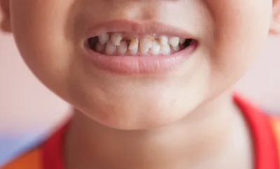 Как исправить кривые зубы: методы без брекеты, причины и способы лечения в  стоматологии