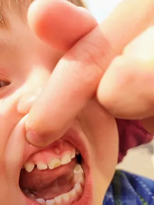 Налет Пристли - темный налет на зубах у ребенка | Удаление налета Пристли