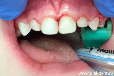 Черные точки на зубах - стоматологическая клиника «Абилис»