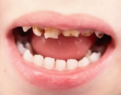 Гнилые зубы у ребенка - причины, симптомы, стадии и профилактика