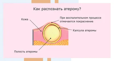 Атерома мошонки: симптомы и лечение атеромы на яичках и половом члене в  Москве