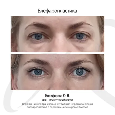 Нижняя блефаропластика в VIP Clinic в Москве. Операция блефаропластика  нижних век глаз. Цены, отзывы и фото на сайте клиники. Точная стоимость на  консультации