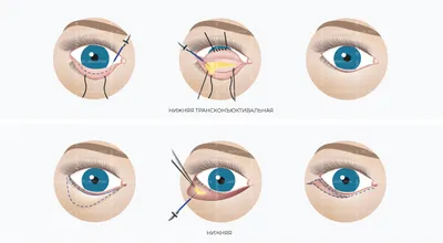 Лазерная блефаропластика Smooth Eye - омоложение век в Санкт-Петербурге