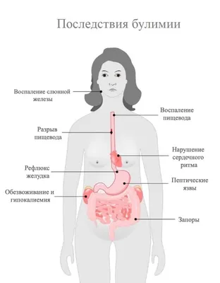Последствия булимии для организма — как проявляется и чем опасно пищевое  расстройство булимия