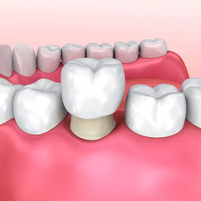 Коронка на зуб — плюсы и минусы по видам, описание, стоимость