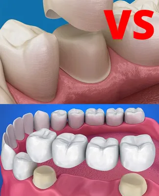 Керамические коронки на зубы: цена установки на передние и жевательные |  НоваДент