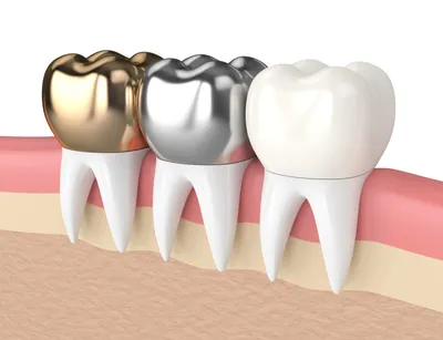Когда нельзя ставить коронку на зуб, а когда можно поставить ?