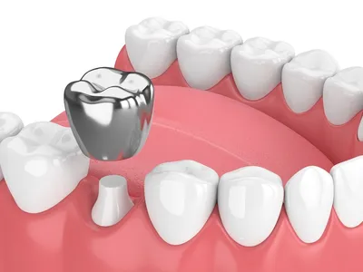 Коронки на штифте для протезирования зубов | СКАЙКЛИНИК
