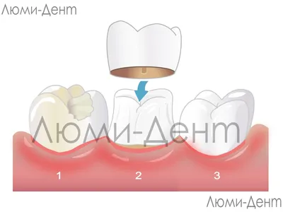 От чего зависит стоимость коронки на зуб? - Cтоматология Май