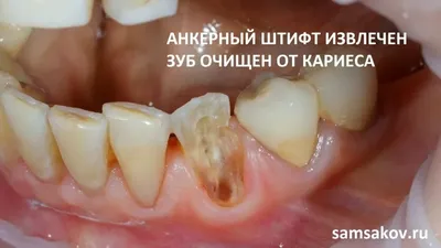 Коронка на передние зубы | Виды, преимущества, недостатки | Клиника  семейной стоматологии Дока-Дент